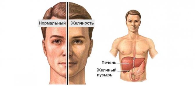 Симптомы синдрома Жильбера