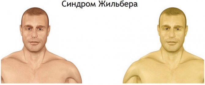 Синдром Жильбера