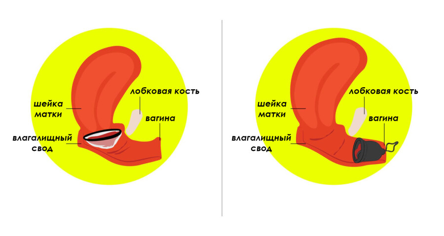 менструальный диск и чаша